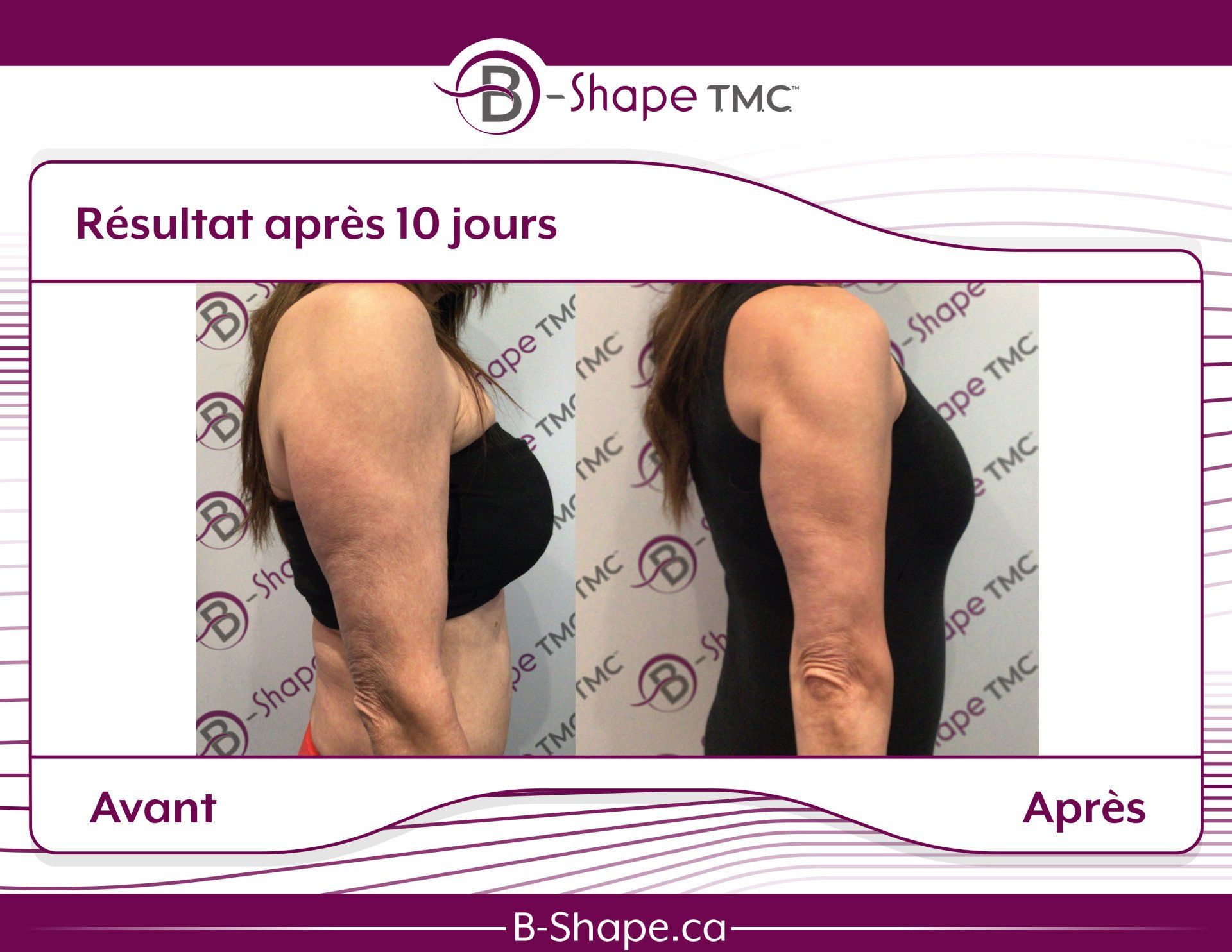 Photos avant/après du bras d'une femme après 10 jours. Le bras « après » paraît plus ferme.