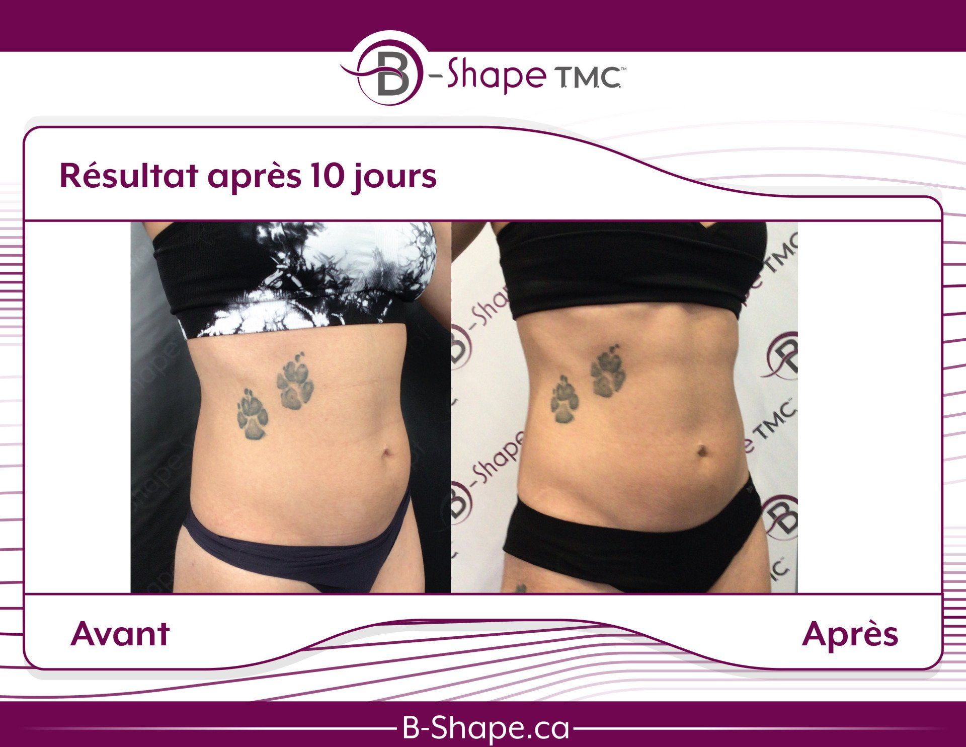 Images avant/après du ventre d'une femme. La photo après montre une apparence plus tonique après 10 jours.