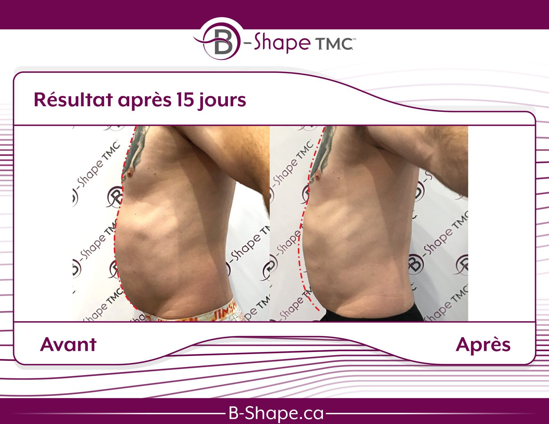 Comparaison côte à côte du torse d'une personne avant et après 15 jours de traitement B-Shape, montrant une réduction de la graisse du ventre.