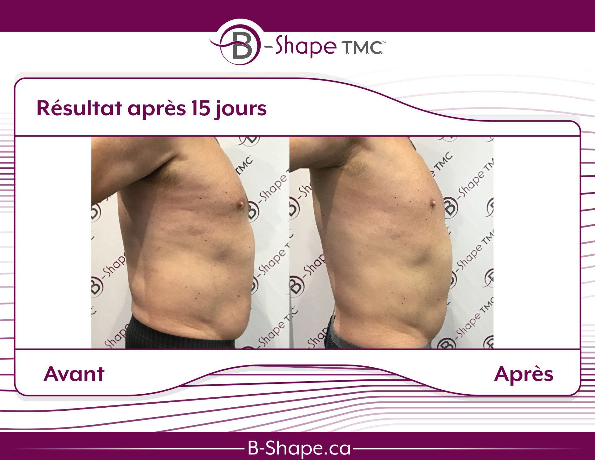 Photos avant/après du torse d'une personne. Résultats après 15 jours de traitement B-Shape TMC, montrant un amincissement de l'abdomen.