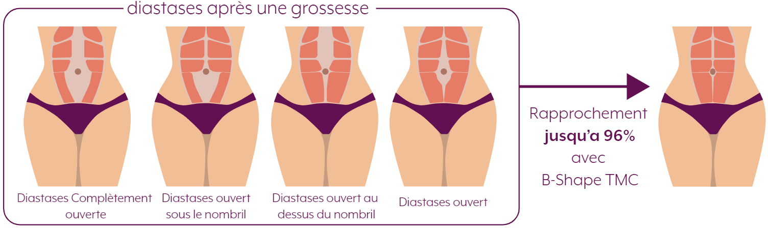 Diagramme montrant la diastase abdominale après la grossesse et les résultats potentiels du traitement.