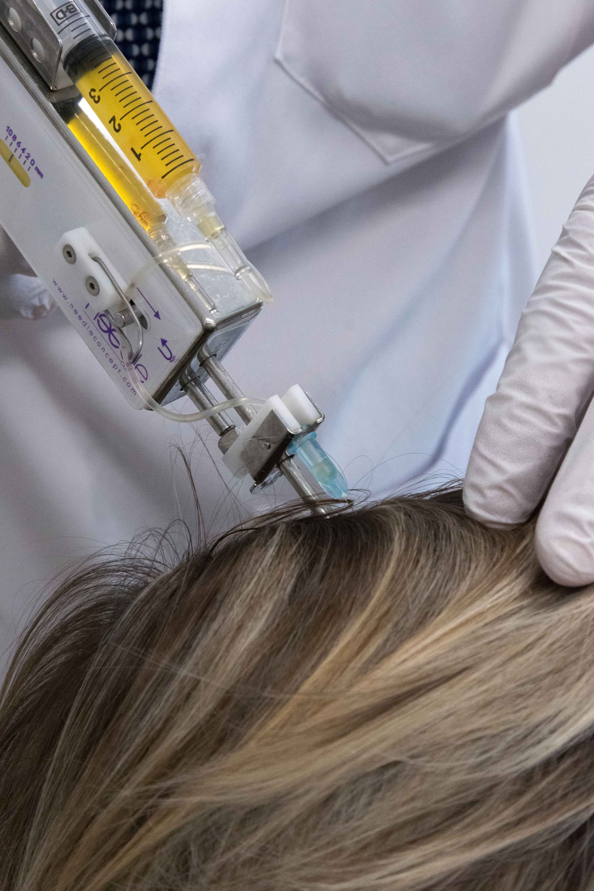 Scalp treatment being injected with a syringe by gloved hands