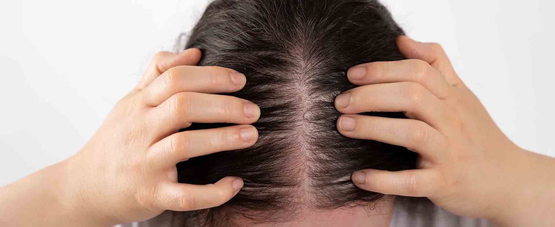 Gros plan sur des mains séparant des cheveux foncés pour révéler un cuir chevelu sec, squameux et irrité sur fond blanc uni.