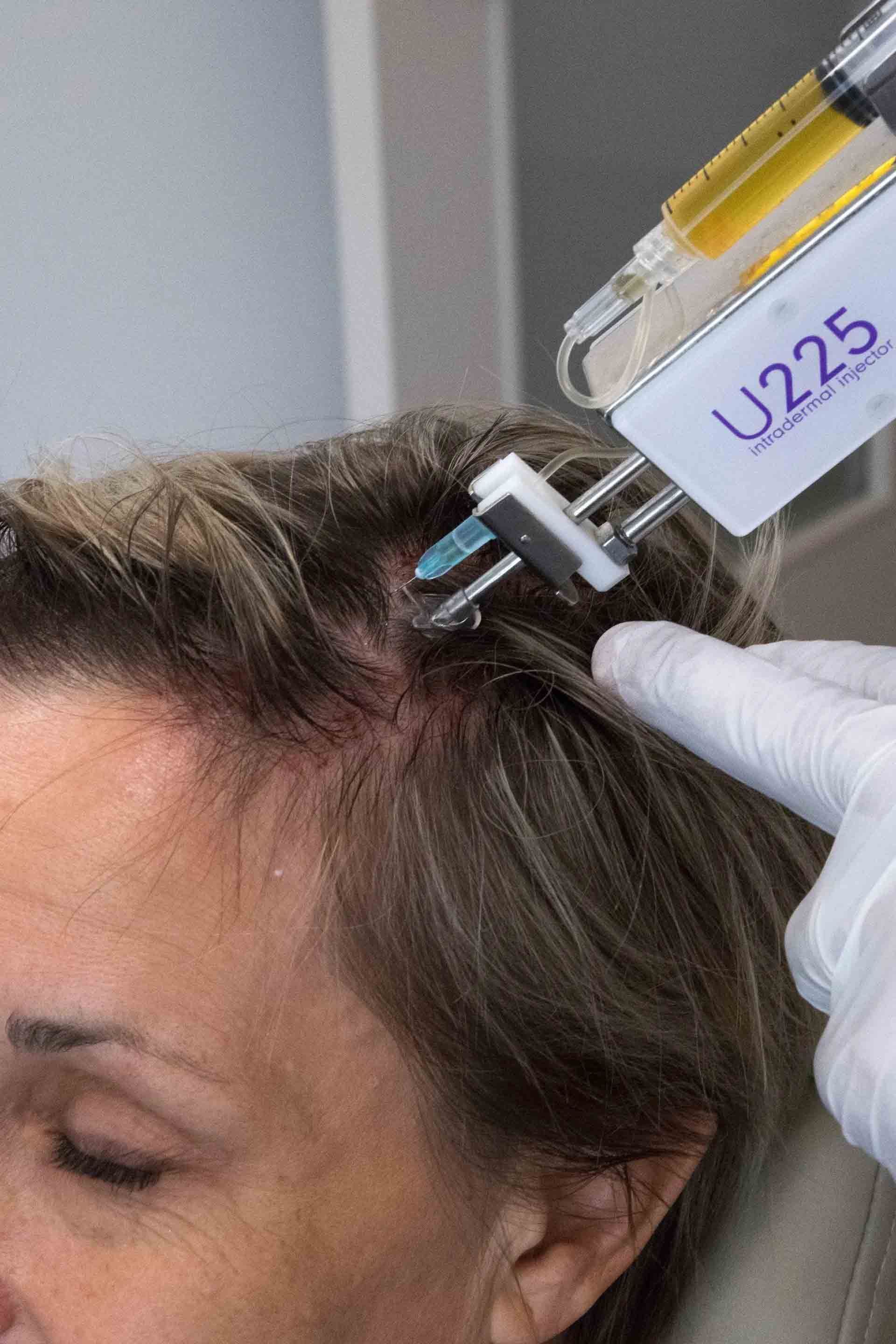 Gloved hand injecting scalp with syringe labeled “U225”
