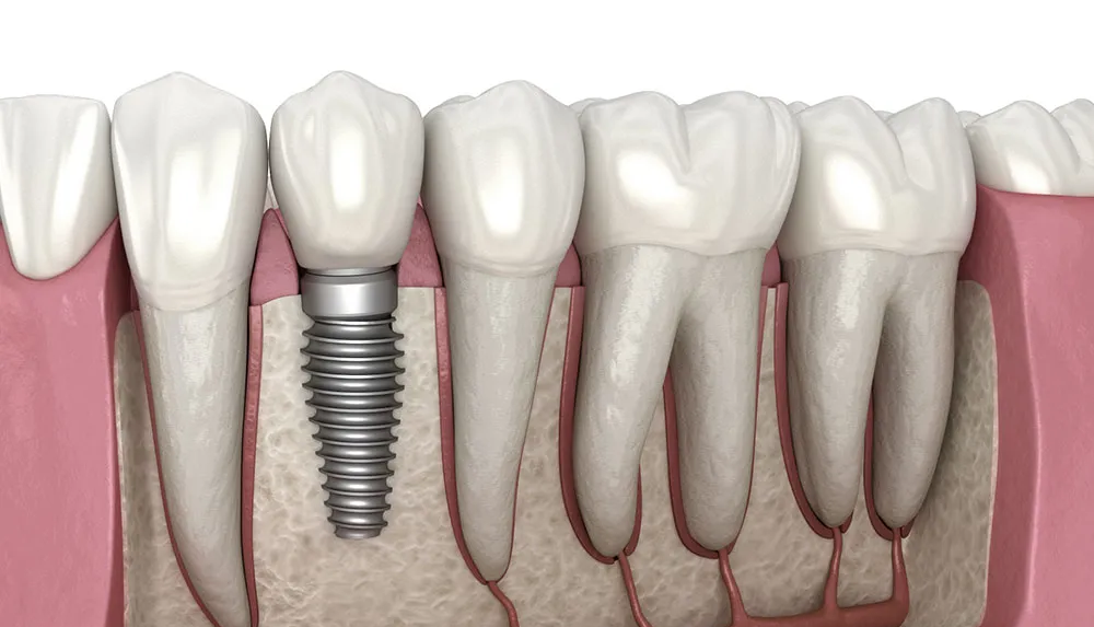 Cross-section of teeth and gums showing a dental implant screw replacing a missing tooth