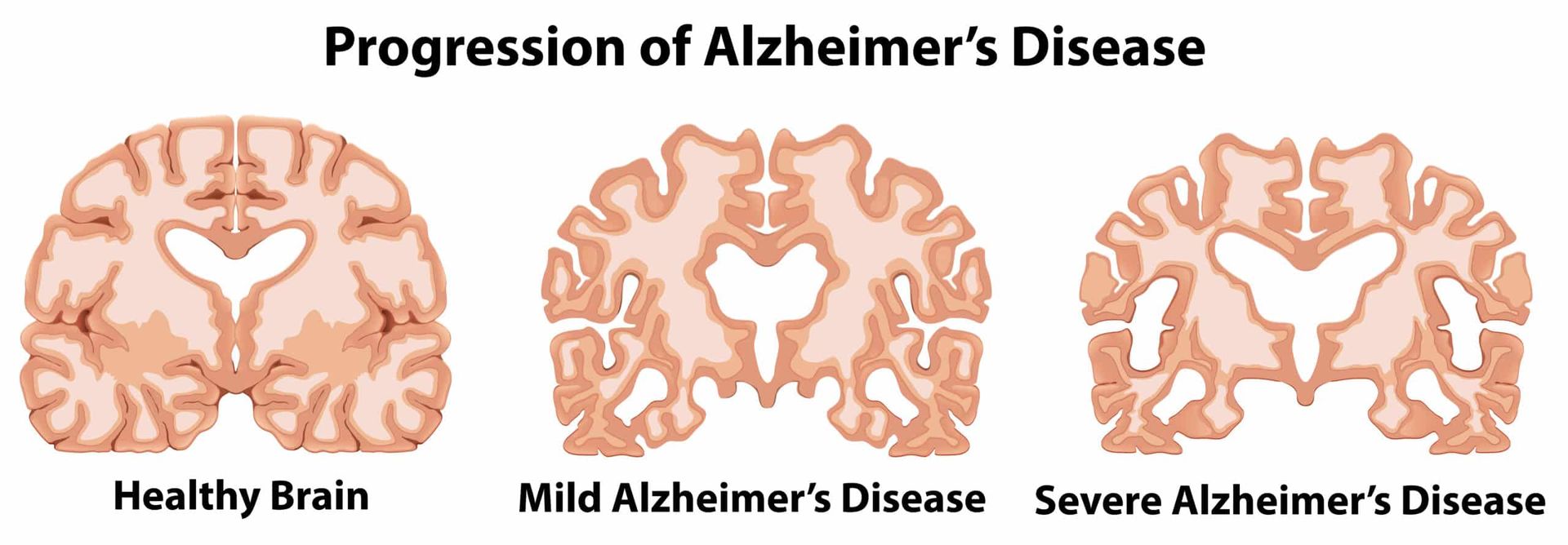 Diagram showing the progression of Alzheimer's disease in brain: healthy brain, mild, and severe Alzheimer's.