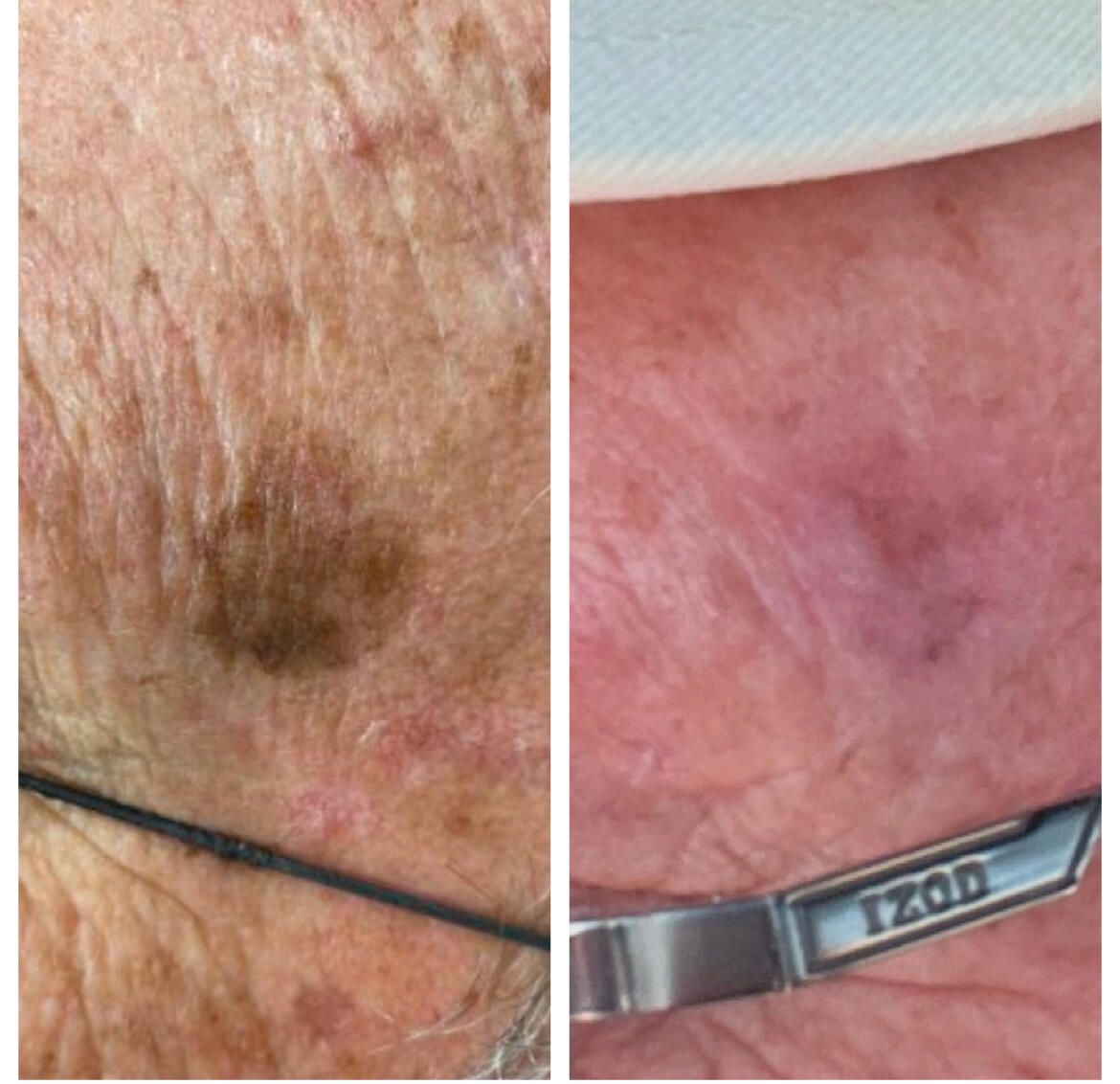 Before and after laser sunspot removal treatment.