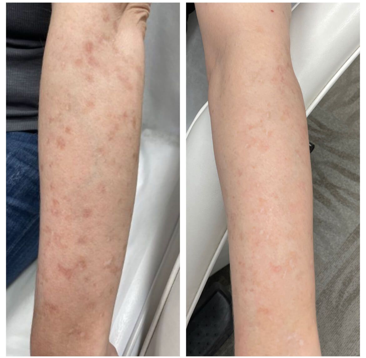 Before and after laser sunspot treatment.