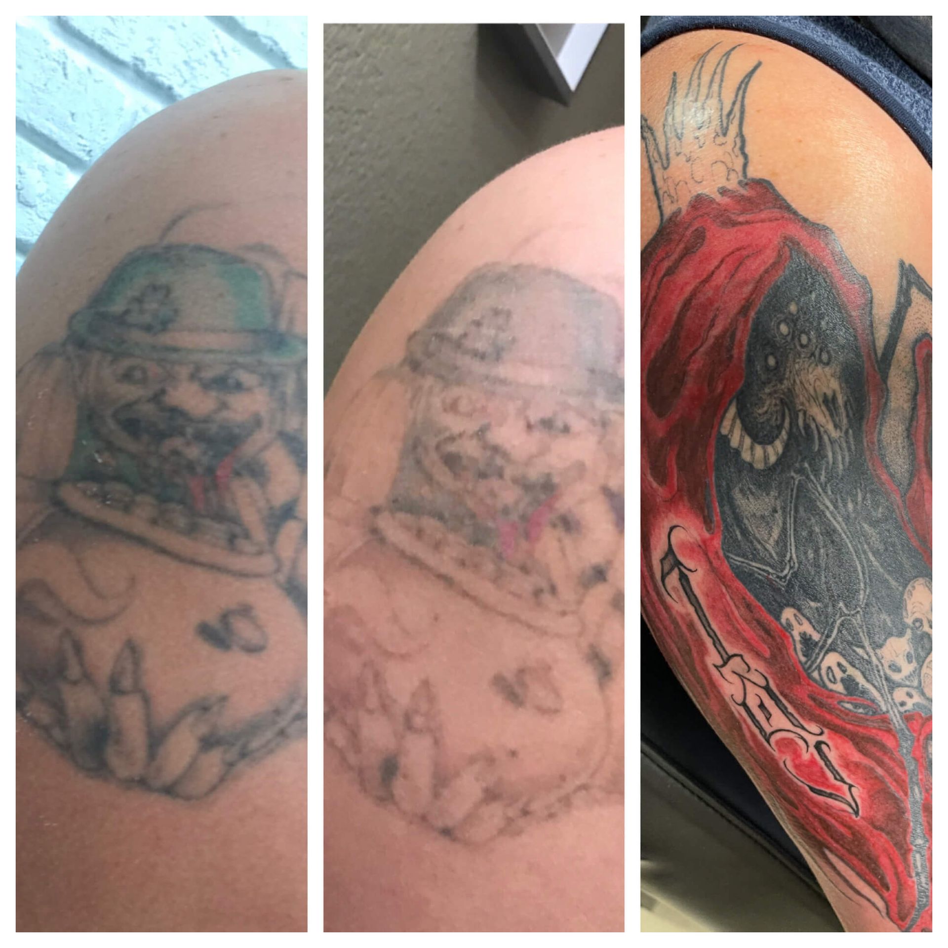 Progressive results of laser tattoo fading for a new tattoo.