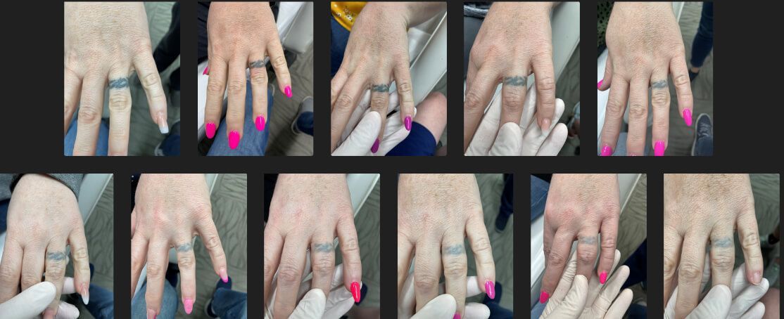 Before and after laser tattoo removal.