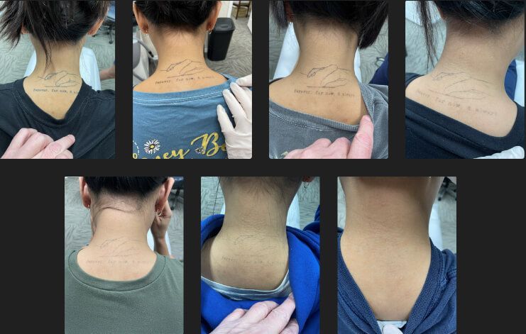 Before and after laser tattoo removal.
