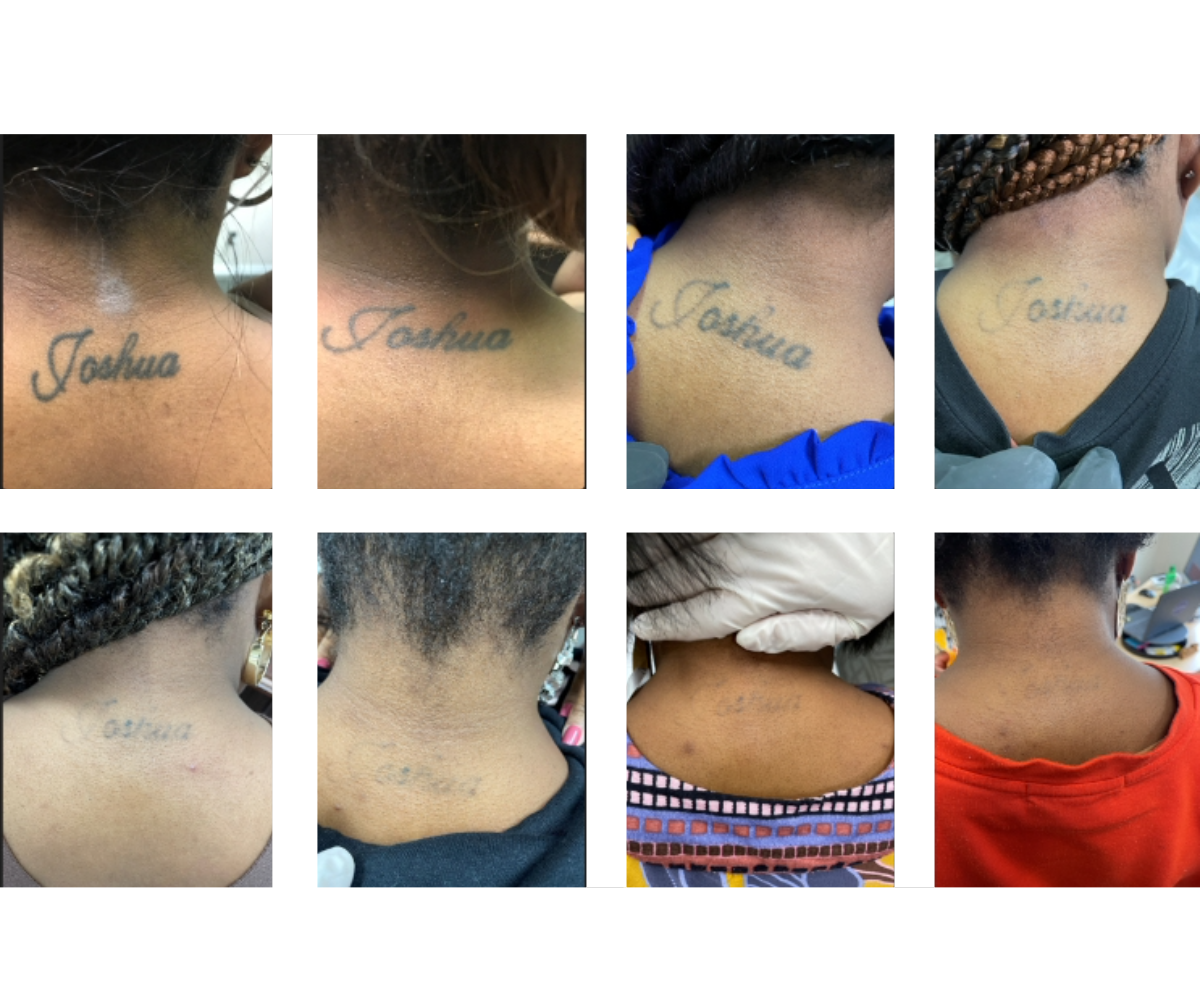 Before and after results of laser tattoo removal.