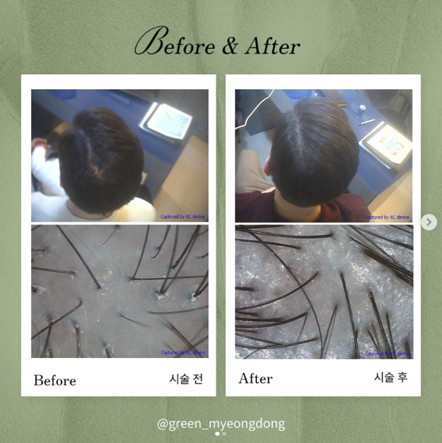 Green Scalp Care before and after result 10