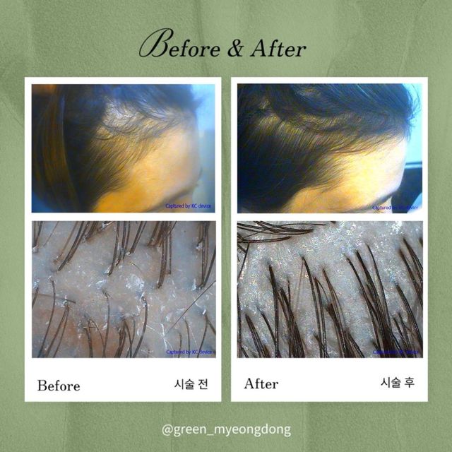 Green Scalp Care before and after result 1