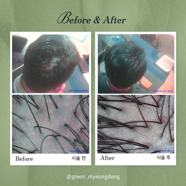 Green Scalp Care before and after result 6
