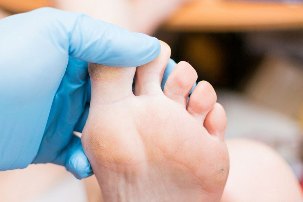 A Person Wearing Blue Gloves Is Examining A Person's Foot — Lake Macquarie Podiatry in Rathmines, NSW