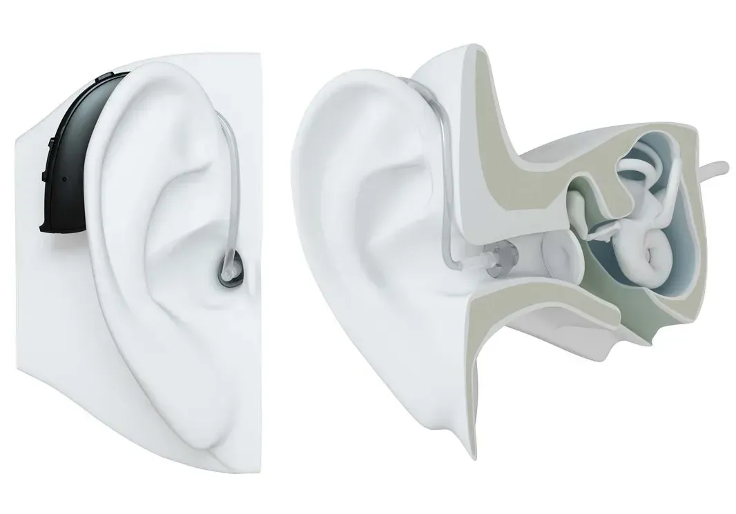 Hearing aid shown on an ear, with a cutaway revealing the inner components
