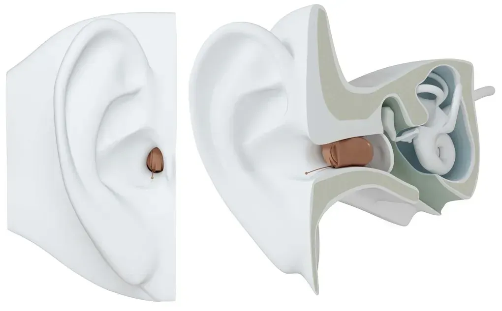 Cutaway illustration of an ear showing the eardrum and inner ear structures