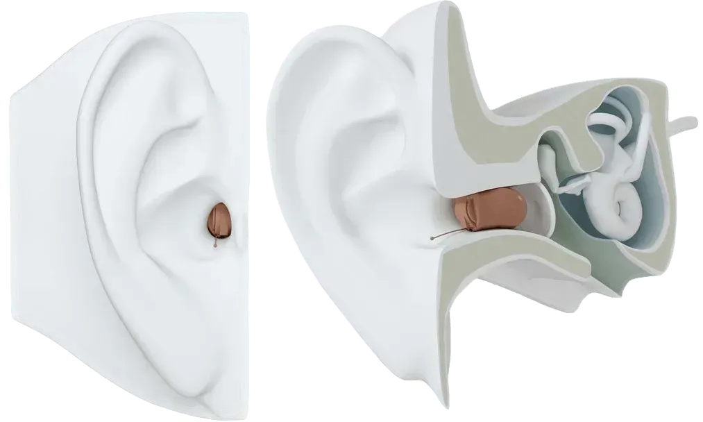 Ear with a beige earplug shown from the side and in cross-section