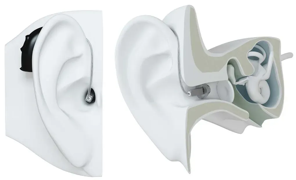 Diagram of a white ear with a hearing aid and cutaway showing inner ear structures