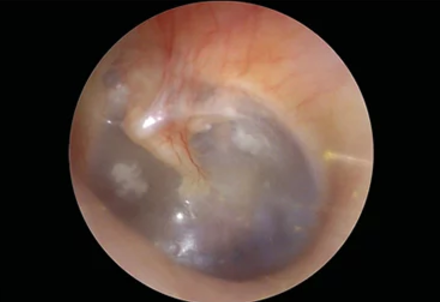 Close-up otoscopic view of a reddish ear canal and gray eardrum with cloudy patches