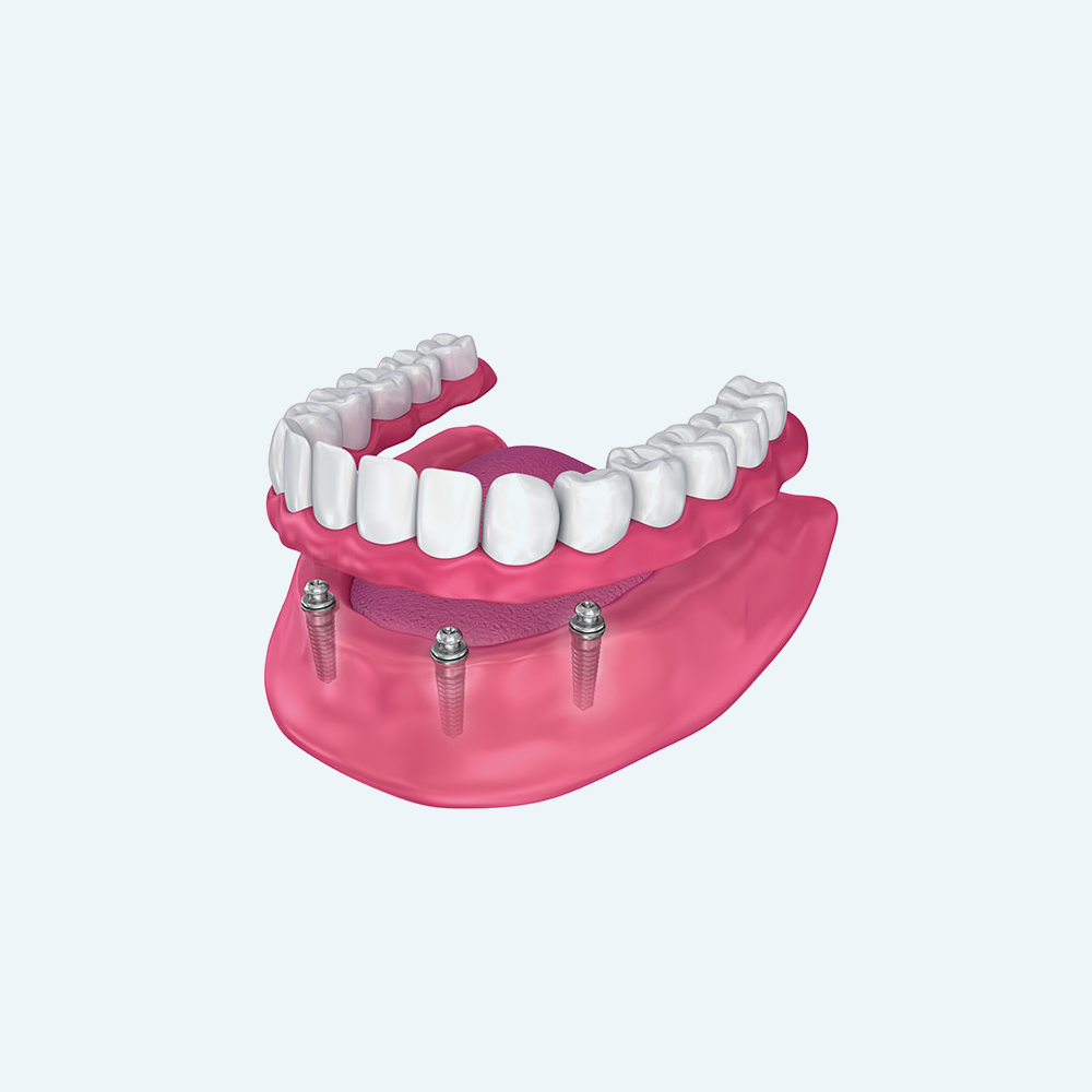 Dentures attached to dental implants, pink gums, white teeth, light blue background.