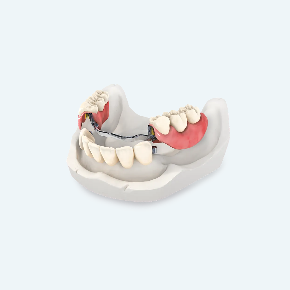 Partial denture model on a white mold, showcasing teeth and pink gum, with metal clasps.