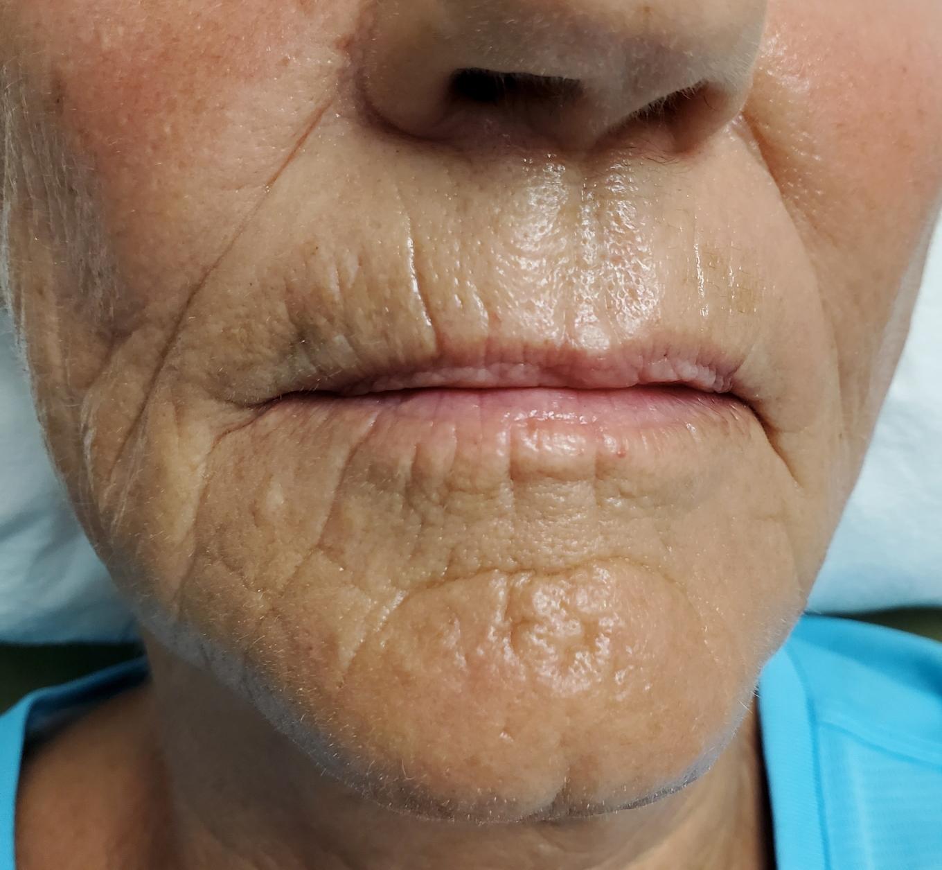 before-lip-fillers