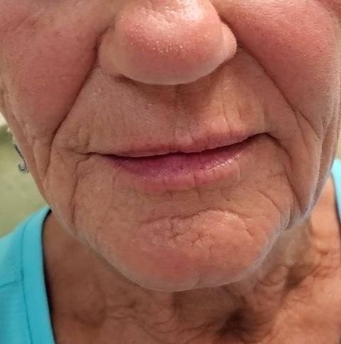 after-lip-fillers