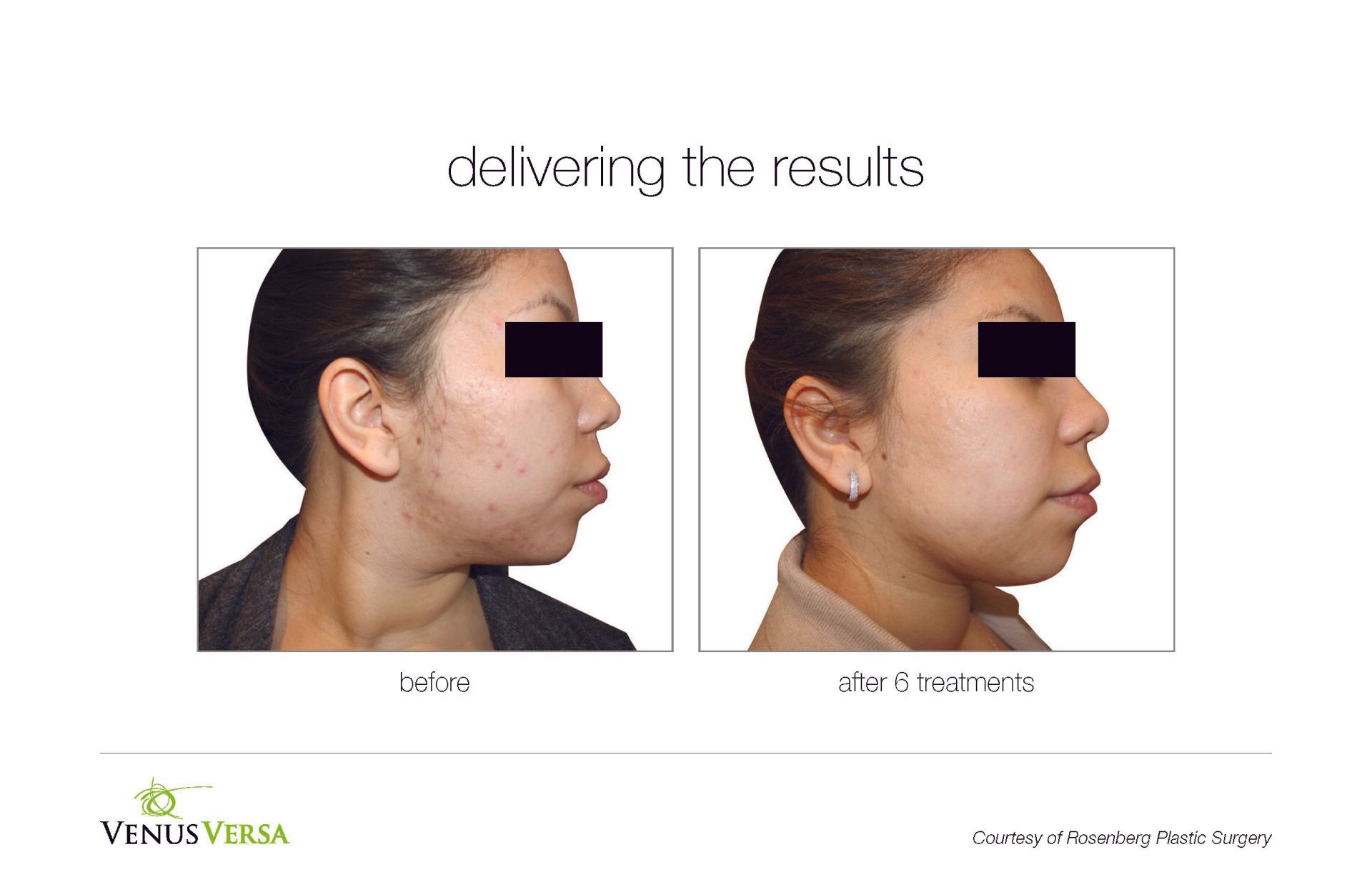 before and after photos of IPL skin tightening patient