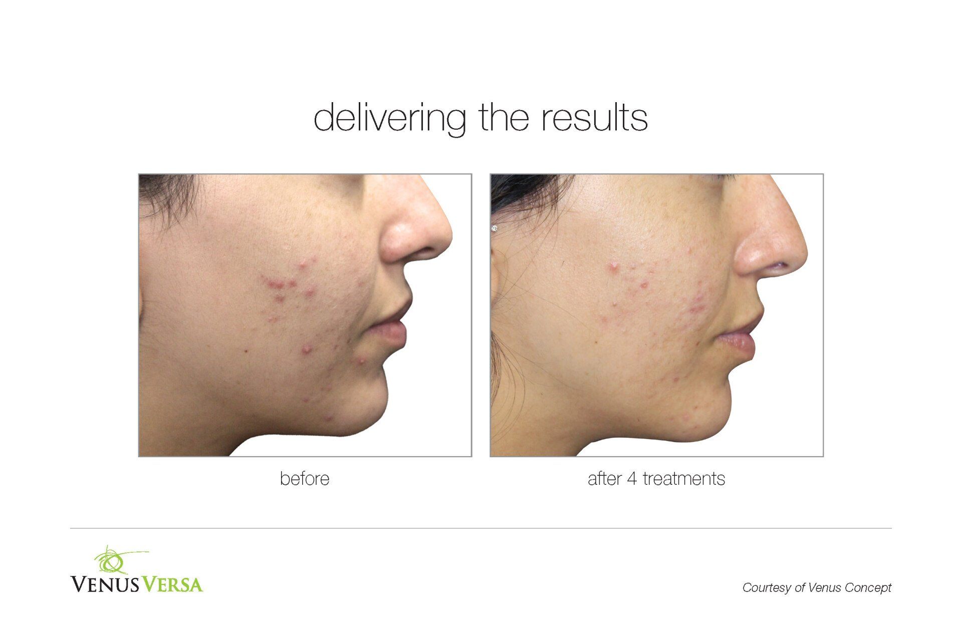 before and after photos of IPL skin tightening patient