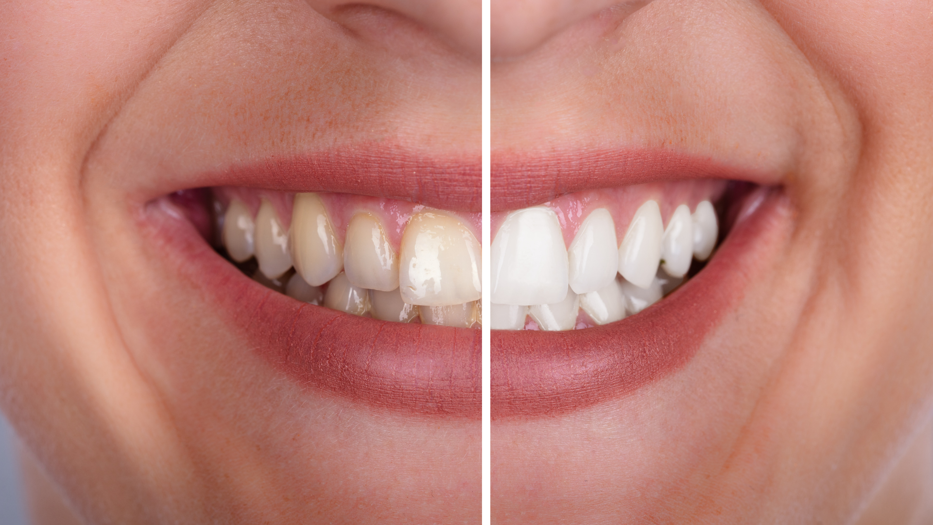 Comparison of teeth before and after whitening, showing a brighter smile.