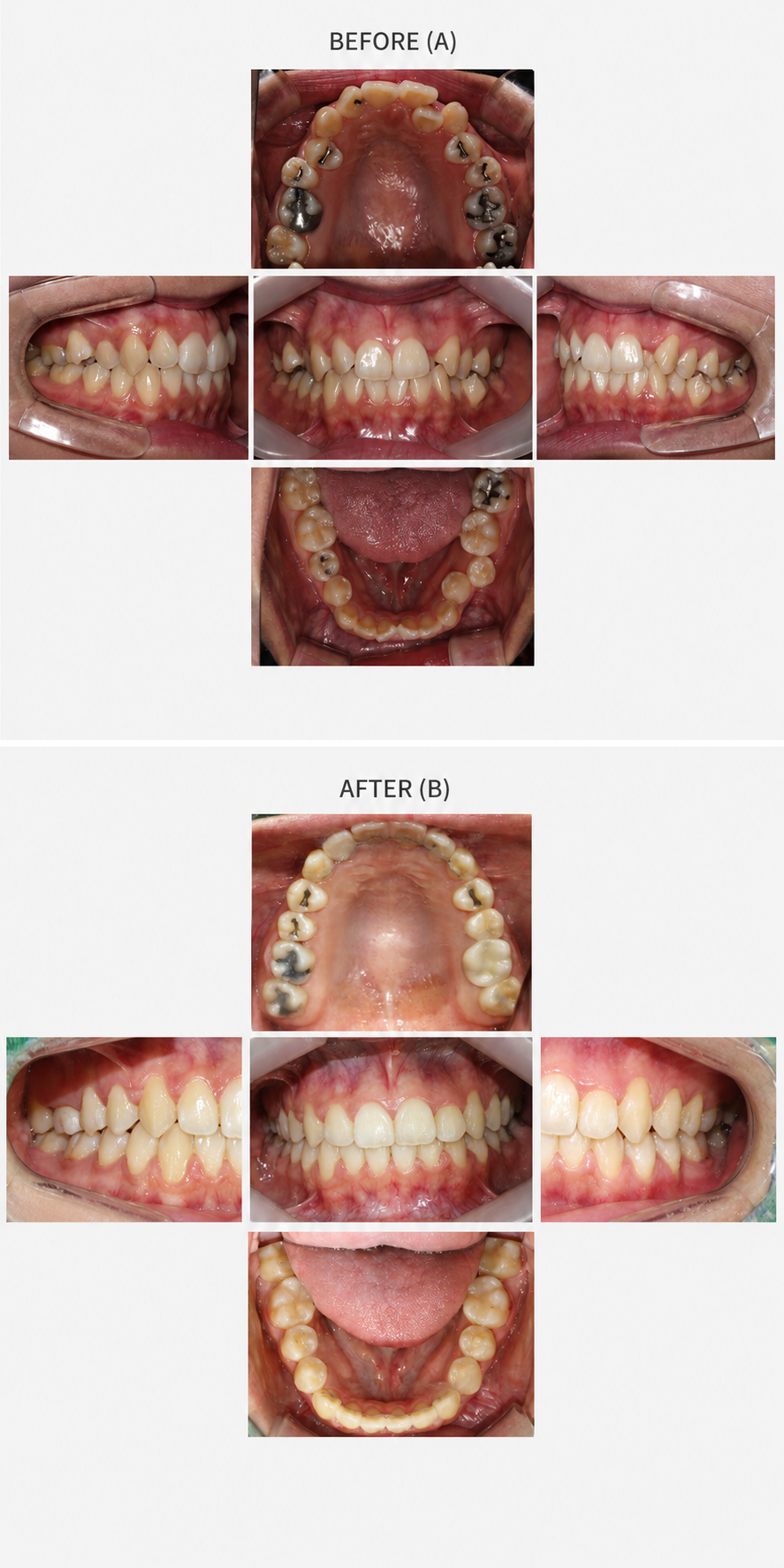 Crossbite before and after at Baro Dental Clinic Busan — orthodontic case 14