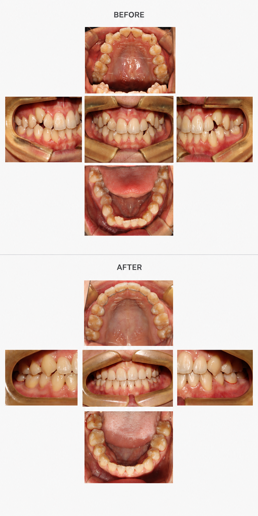 Crossbite before and after at Baro Dental Clinic Busan — orthodontic case 15