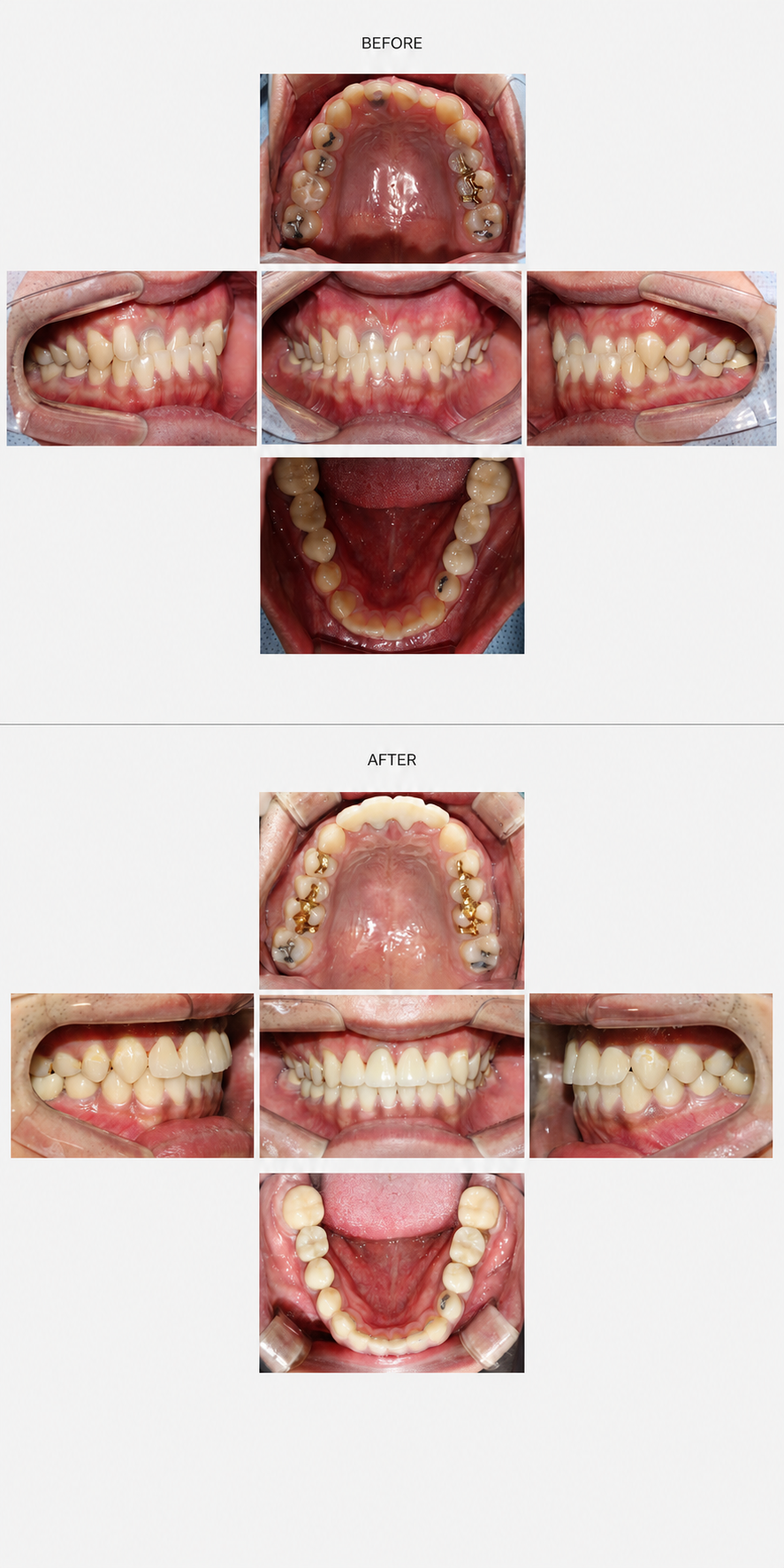 Crossbite before and after at Baro Dental Clinic Busan — orthodontic case 16