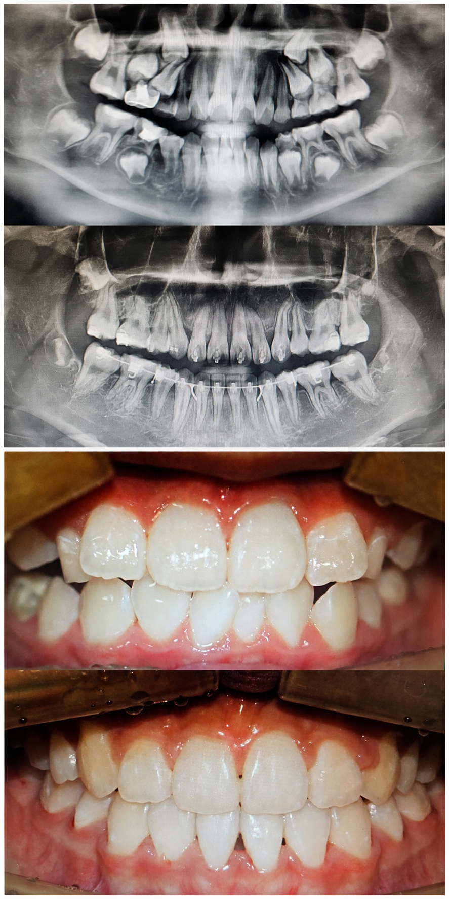 Crowding before and after at Baro Dental Clinic Busan — orthodontic case 3
