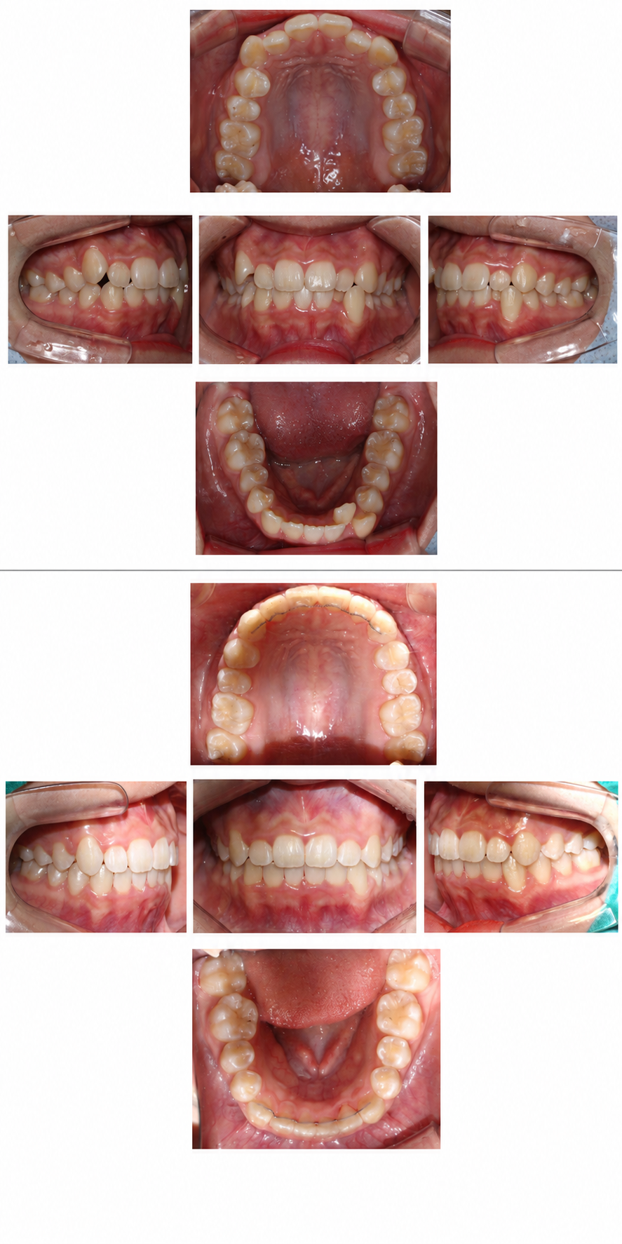 Crowding before and after at Baro Dental Clinic Busan — orthodontic case 4