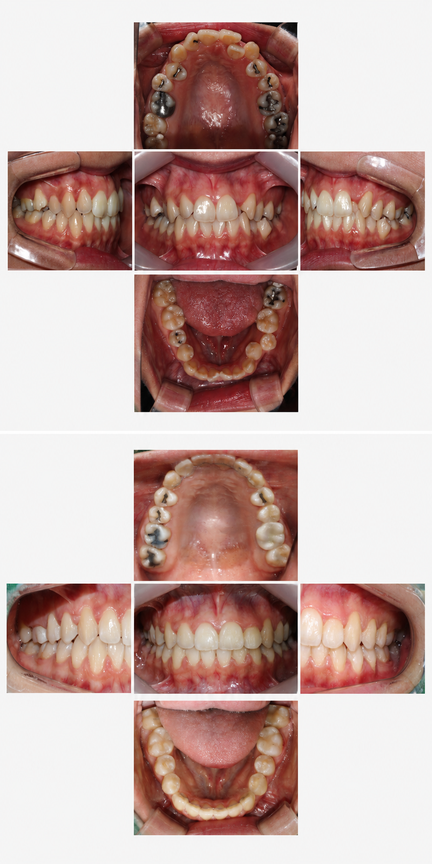 Crowding before and after at Baro Dental Clinic Busan — orthodontic case 5