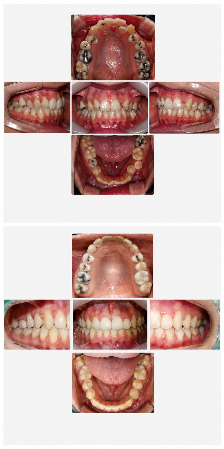 Crowding before and after at Baro Dental Clinic Busan — orthodontic case 6