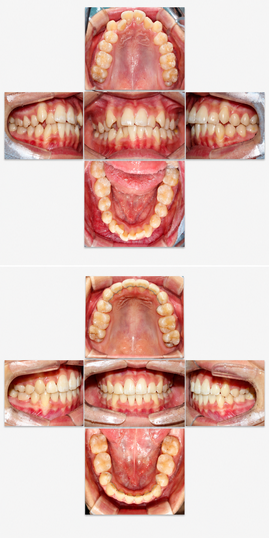 Crowding before and after at Baro Dental Clinic Busan — orthodontic case 7