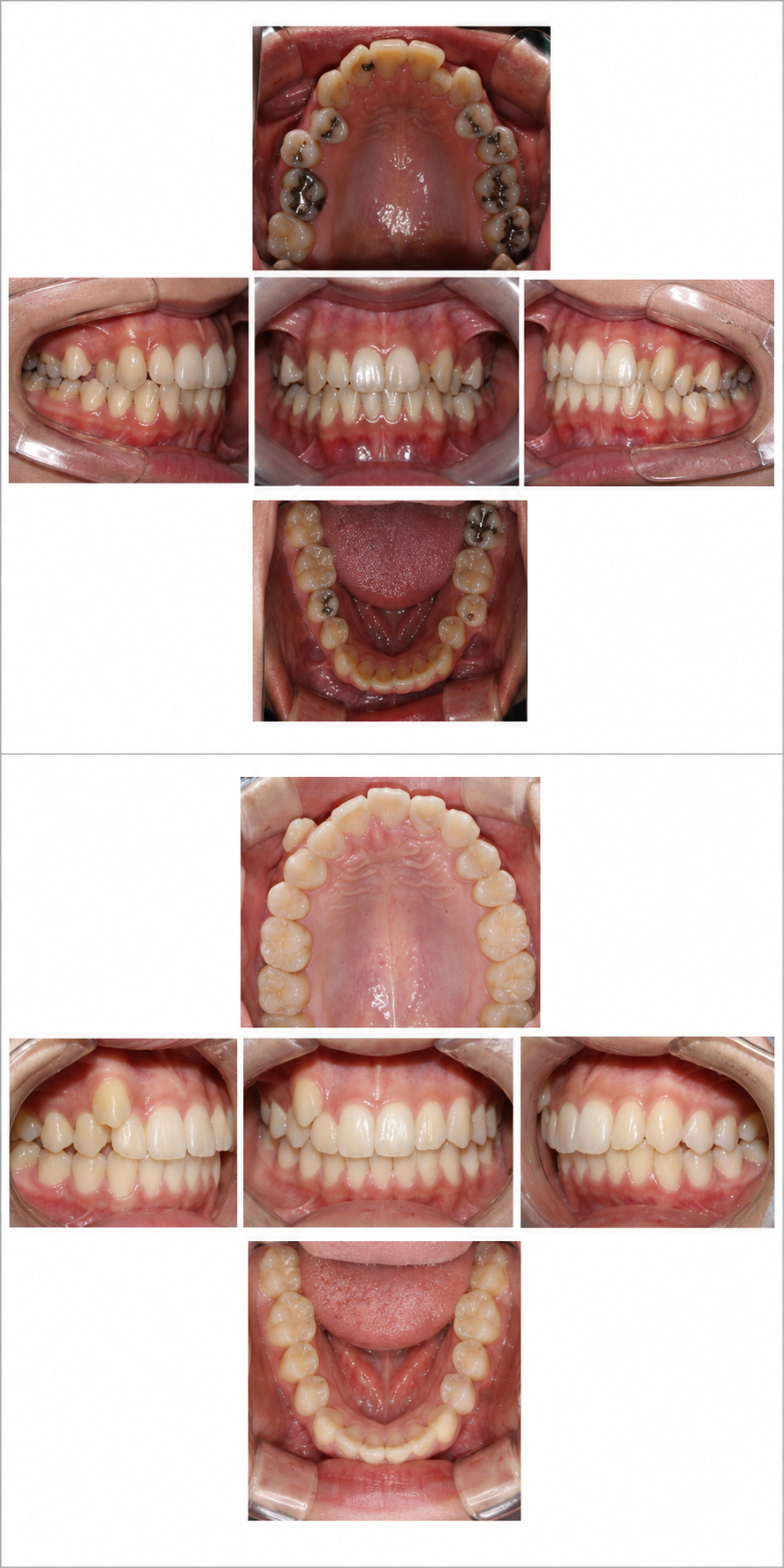 Crowding before and after at Baro Dental Clinic Busan — orthodontic case 8