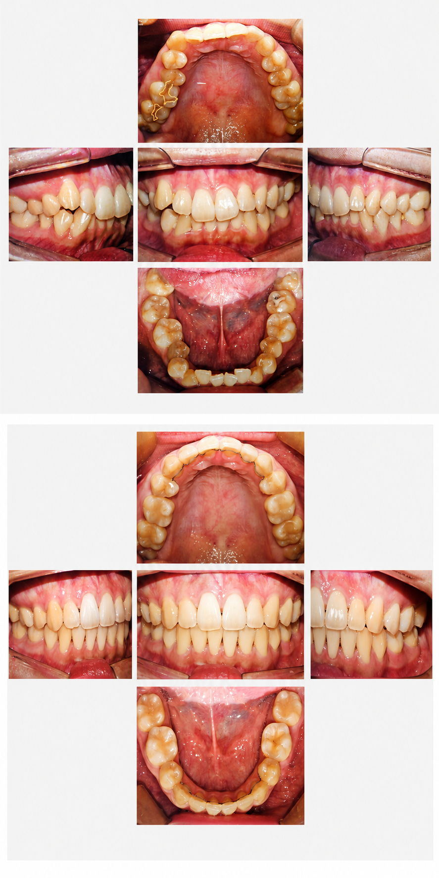 Deep bite before and after at Baro Dental Clinic Busan — orthodontic case 17