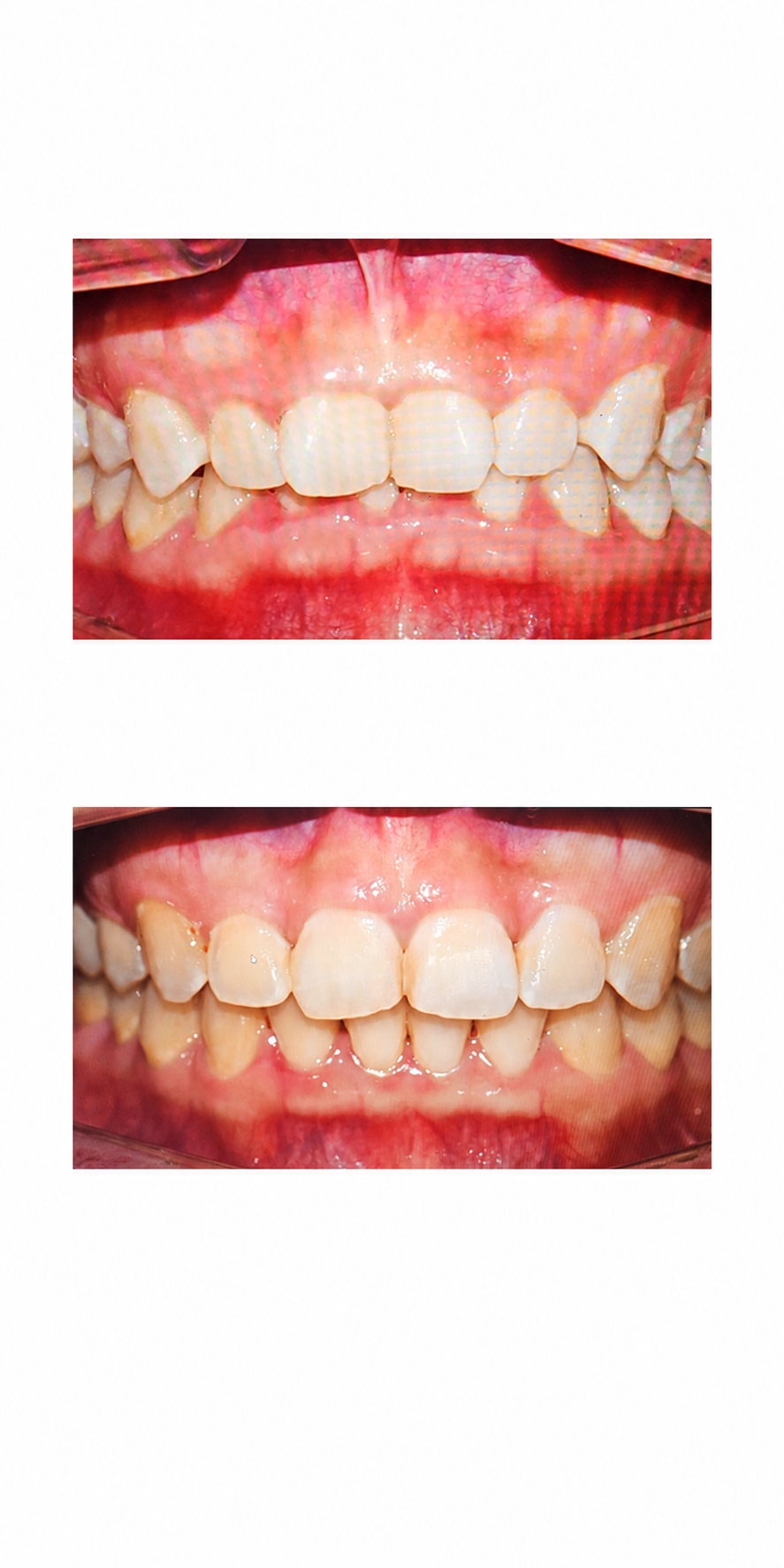 Deep bite before and after at Baro Dental Clinic Busan — orthodontic case 18