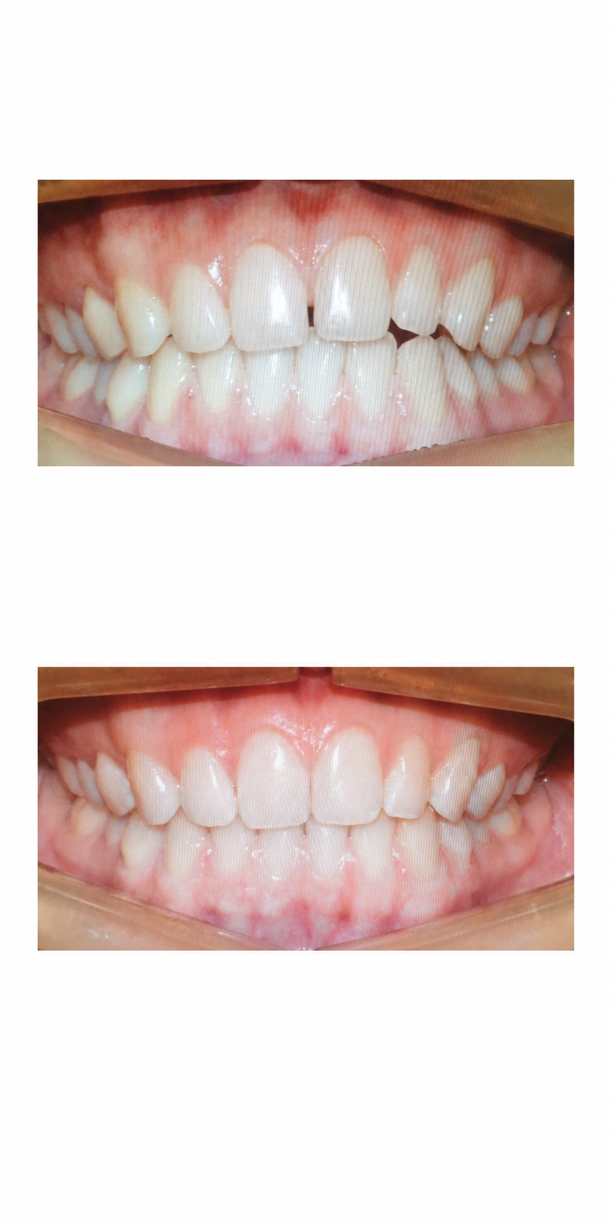 Clear aligner treatment before and after at Baro Dental Clinic Busan — orthodontic case 1