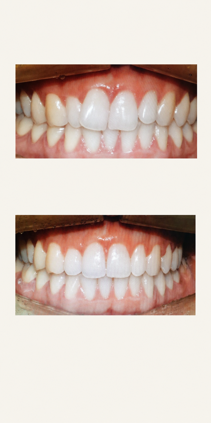 Clear aligner treatment before and after at Baro Dental Clinic Busan — orthodontic case 2