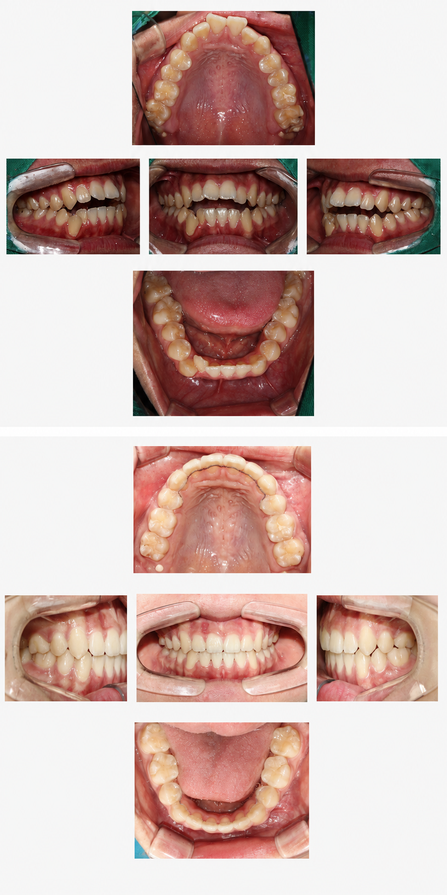 Open bite before and after at Baro Dental Clinic Busan — orthodontic case 19