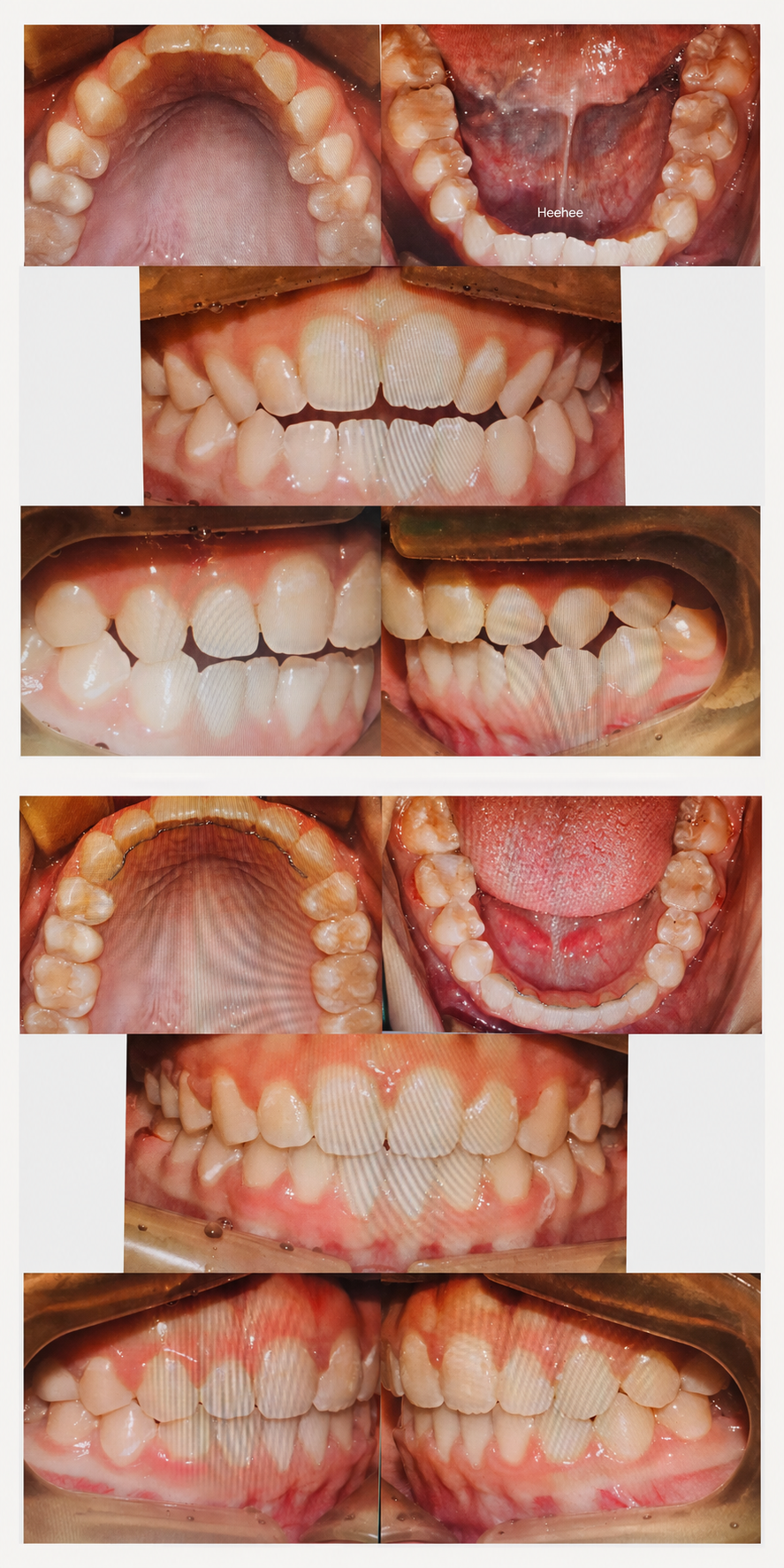 Open bite before and after at Baro Dental Clinic Busan — orthodontic case 20