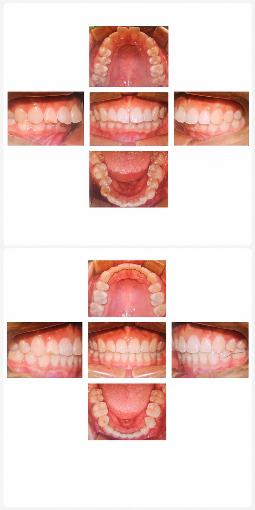 Protruding teeth before and after at Baro Dental Clinic Busan — orthodontic case 9