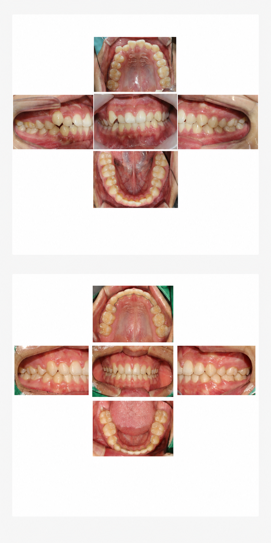 Protruding teeth before and after at Baro Dental Clinic Busan — orthodontic case 10