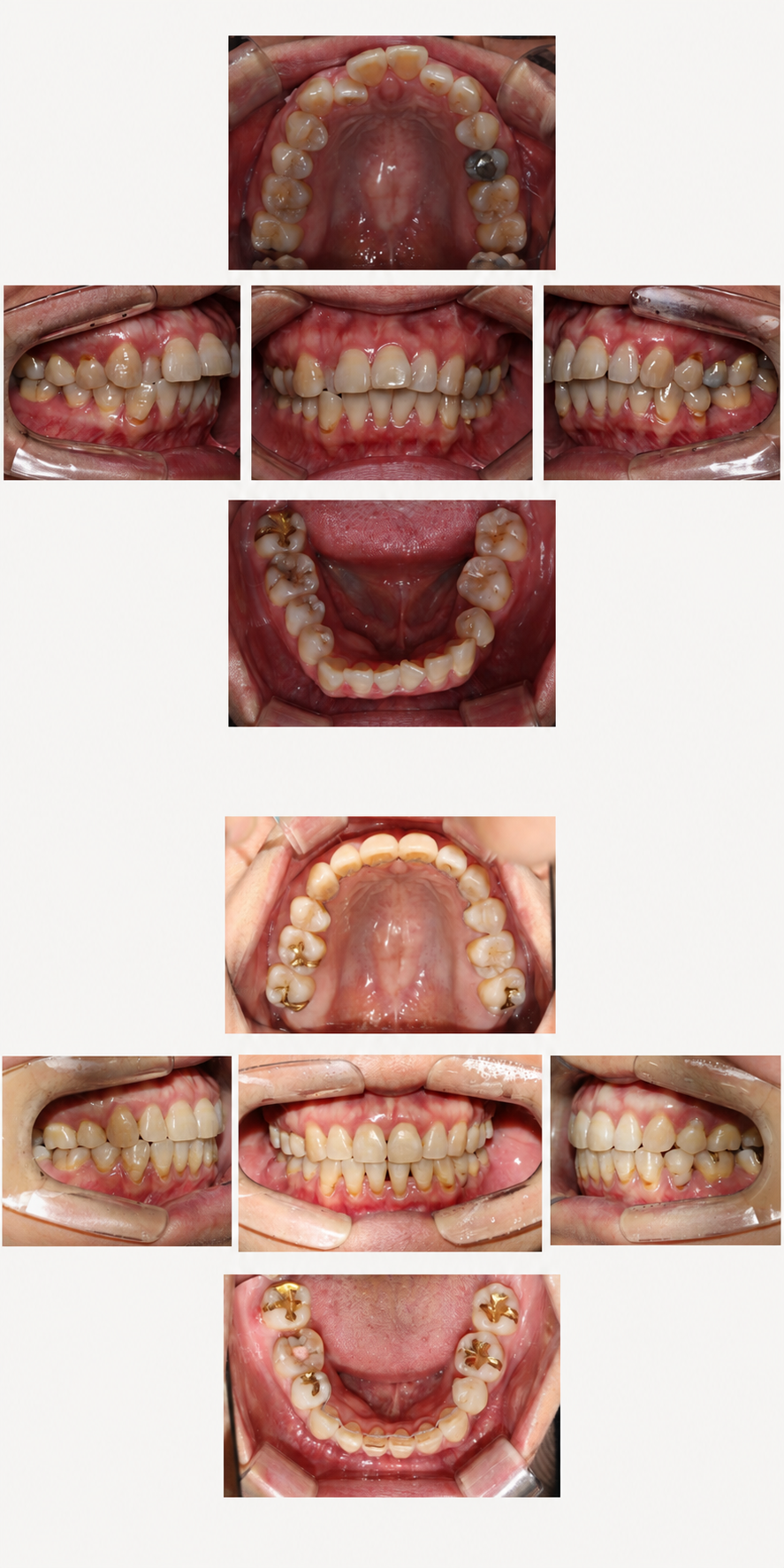 Protruding teeth before and after at Baro Dental Clinic Busan — orthodontic case 11